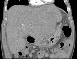 Hepatocellular Carcinoma (Hepatoma) With CTA - CTisus CT Scan