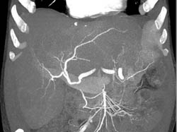 Hepatocellular Carcinoma (Hepatoma) With CTA - CTisus CT Scan