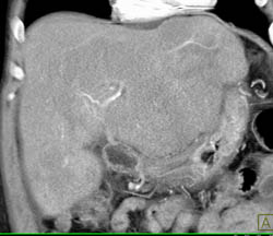 Lymphoma of the Liver - CTisus CT Scan