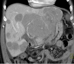 Lymphoma of the Liver - CTisus CT Scan