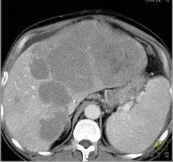 Lymphoma of the Liver - CTisus CT Scan