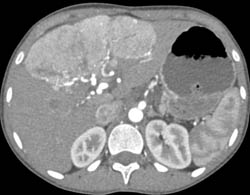 Focal Nodular Hyperplasia (FNH) in A 11 Year Old Female - CTisus CT Scan