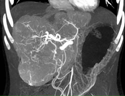 Focal Nodular Hyperplasia (FNH) in A 11 Year Old Female - CTisus CT Scan