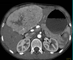 Focal Nodular Hyperplasia (FNH) in A 11 Year Old Female - CTisus CT Scan