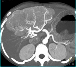 Focal Nodular Hyperplasia (FNH) in A 11 Year Old Female - CTisus CT Scan