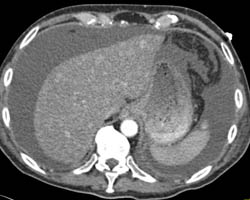 Cirrhosis With Regenerative Nodules - CTisus CT Scan