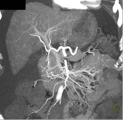 Cirrhosis With Regenerative Nodules - CTisus CT Scan