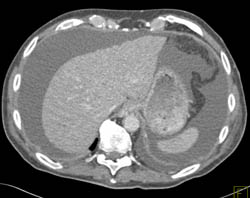 Cirrhosis With Regenerative Nodules - CTisus CT Scan