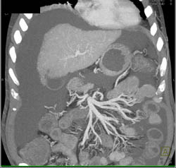 Cirrhosis With Regenerative Nodules - CTisus CT Scan