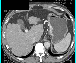 Cirrhosis With Varices - CTisus CT Scan