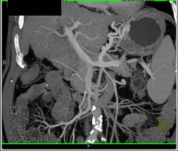 Cirrhosis With Varices - CTisus CT Scan