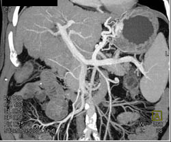 Cirrhosis With Varices - CTisus CT Scan