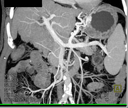 Cirrhosis With Varices - CTisus CT Scan