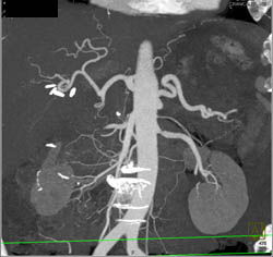 Cirrhosis With Varices - CTisus CT Scan