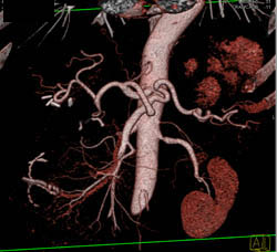 Cirrhosis With Varices - CTisus CT Scan