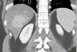 Focal Nodular Hyperplasia (FNH) - CTisus CT Scan