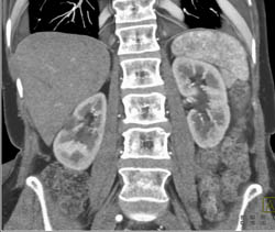 Giant Hemangiomas - CTisus CT Scan