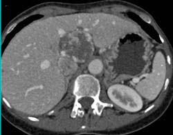 Giant Hemangiomas - CTisus CT Scan