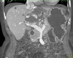 Giant Hemangiomas - CTisus CT Scan