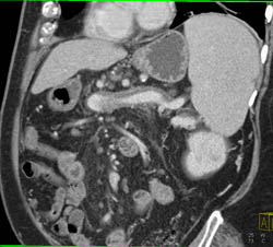 Partial Thrombosis of the Splenic Vein - CTisus CT Scan