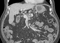 Partial Thrombosis of the Splenic Vein - CTisus CT Scan