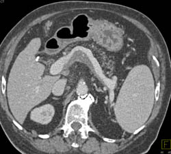 Partial Thrombosis of the Splenic Vein - CTisus CT Scan