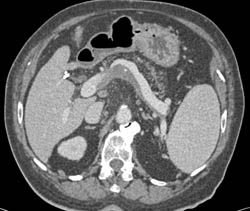 Partial Thrombosis of the Splenic Vein - CTisus CT Scan