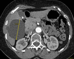 Liver Cyst - CTisus CT Scan