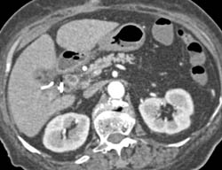 Partial Thrombosis of the Portal Vein - CTisus CT Scan