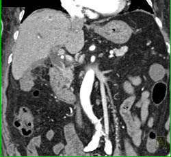 Cholangiocarcinoma of the Distal Common Bile Duct (CBD) Which Is Enhancing- See Full Sequence - CTisus CT Scan