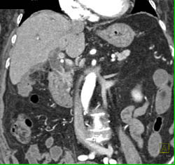 Cholangiocarcinoma of the Distal Common Bile Duct (CBD) Which Is Enhancing- See Full Sequence - CTisus CT Scan