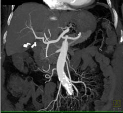 Cholangiocarcinoma of the Distal Common Bile Duct (CBD) Which Is Enhancing- See Full Sequence - CTisus CT Scan