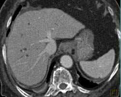 Cholangiocarcinoma of the Distal Common Bile Duct (CBD) Which Is Enhancing- See Full Sequence - CTisus CT Scan