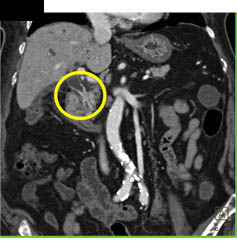 Cholangiocarcinoma of the Distal Common Bile Duct (CBD) Which Is