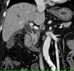 Cholangiocarcinoma of the Distal Common Bile Duct (CBD) Which Is Enhancing- See Full Sequence - CTisus CT Scan