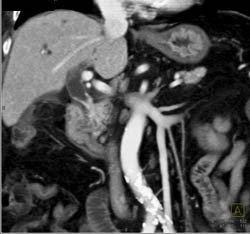 Cholangiocarcinoma of the Distal Common Bile Duct (CBD) Which Is Enhancing- See Full Sequence - CTisus CT Scan