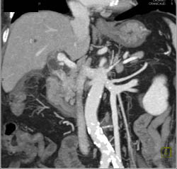 Cholangiocarcinoma of the Distal Common Bile Duct (CBD) Which Is Enhancing- See Full Sequence - CTisus CT Scan