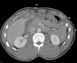 Bleed in and Near Liver S/p Stab Wound - CTisus CT Scan