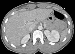 Bleed in and Near Liver S/p Stab Wound - CTisus CT Scan