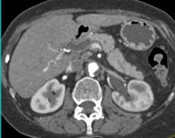 Retroperitoneal Fibrosis With Obstructed Common Bile Duct (CBD) and Left Renal Pelvis- See Full Sequence - CTisus CT Scan