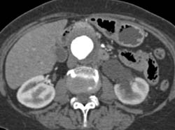 Retroperitoneal Fibrosis With Obstructed Common Bile Duct (CBD) and Left Renal Pelvis- See Full Sequence - CTisus CT Scan