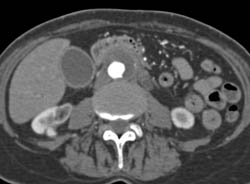 Retroperitoneal Fibrosis With Obstructed Common Bile Duct (CBD) and Left Renal Pelvis- See Full Sequence - CTisus CT Scan