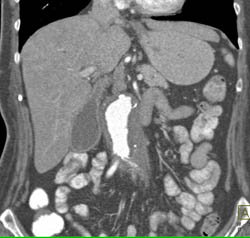 Retroperitoneal Fibrosis With Obstructed Common Bile Duct (CBD) and Left Renal Pelvis- See Full Sequence - CTisus CT Scan