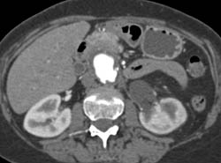 Retroperitoneal Fibrosis With Obstructed Common Bile Duct (CBD) and Left Renal Pelvis- See Full Sequence - CTisus CT Scan