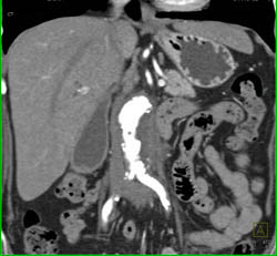 Retroperitoneal Fibrosis With Obstructed Common Bile Duct (CBD) and Left Renal Pelvis- See Full Sequence - CTisus CT Scan