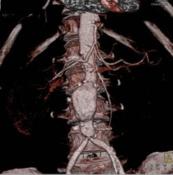 Retroperitoneal Fibrosis With Obstructed Common Bile Duct (CBD) and Left Renal Pelvis- See Full Sequence - CTisus CT Scan