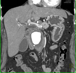 Retroperitoneal Fibrosis With Obstructed Common Bile Duct (CBD) and Left Renal Pelvis- See Full Sequence - CTisus CT Scan