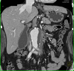 Retroperitoneal Fibrosis With Obstructed Common Bile Duct (CBD) and Left Renal Pelvis- See Full Sequence - CTisus CT Scan