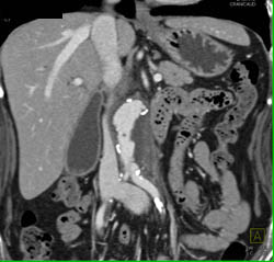 Retroperitoneal Fibrosis With Obstructed Common Bile Duct (CBD) and Left Renal Pelvis- See Full Sequence - CTisus CT Scan