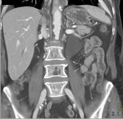 Retroperitoneal Fibrosis With Obstructed Common Bile Duct (CBD) and Left Renal Pelvis- See Full Sequence - CTisus CT Scan